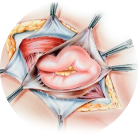 Open Hernia Surgery
