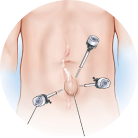 Laparoscopic Hernia Surgery