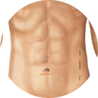 Recurrent Hernia Surgery
