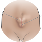 Abdominal Wall Hernia (AWR)
