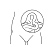 Complex Hernia